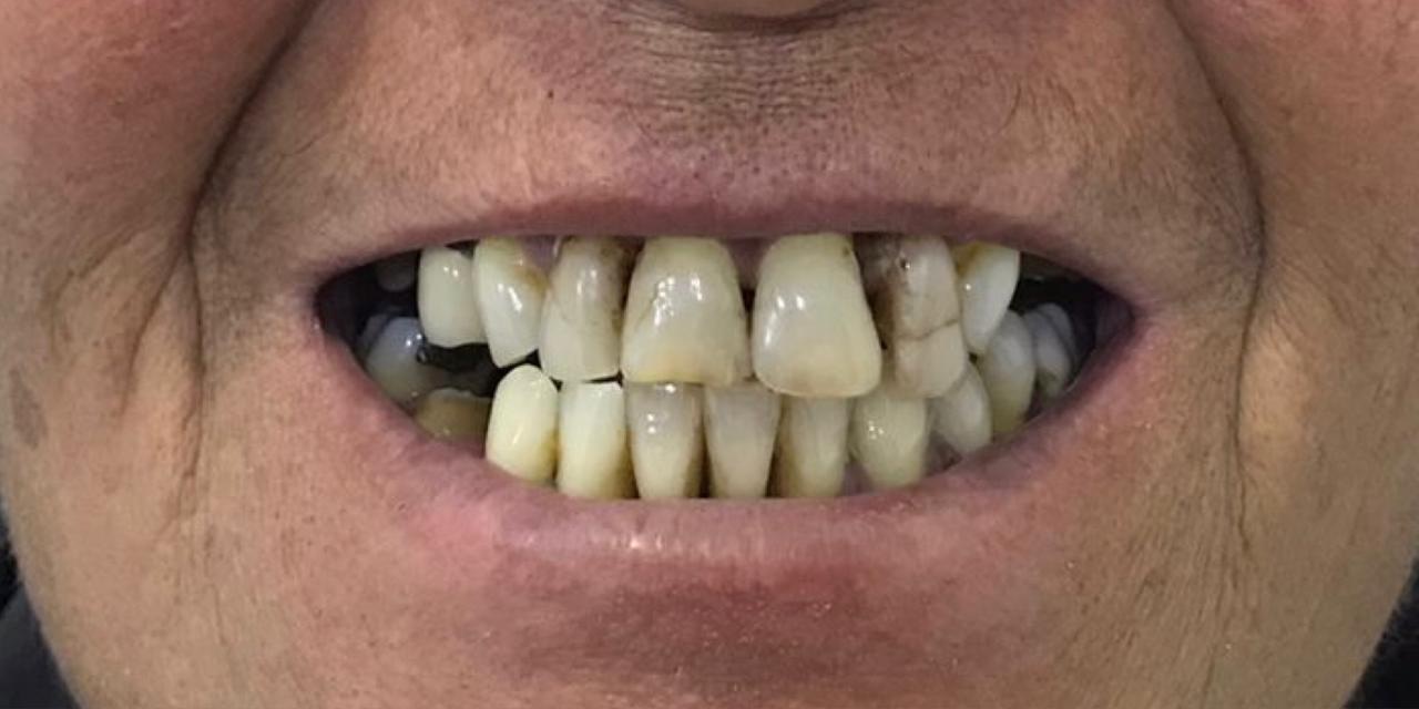 Antes do caso Carga imediata bimaxilar