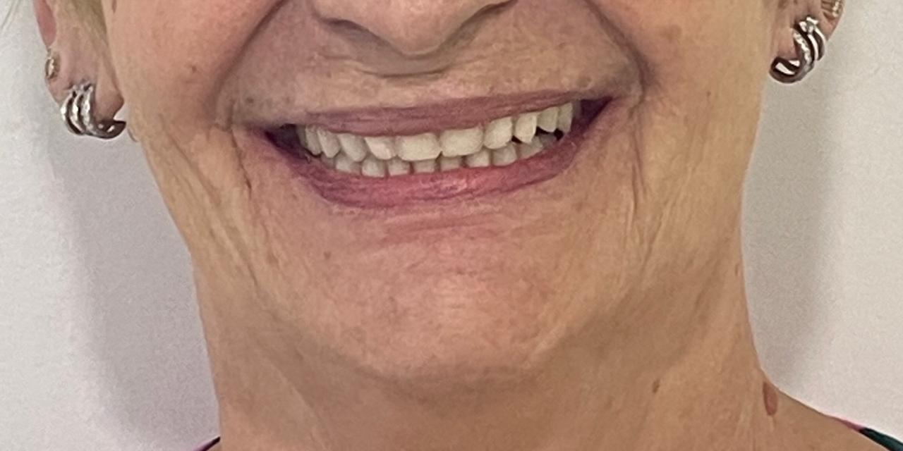 Depois do caso Reabilitação oral